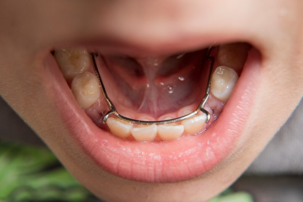 young boy showing off his lingual side dental space maintainer
