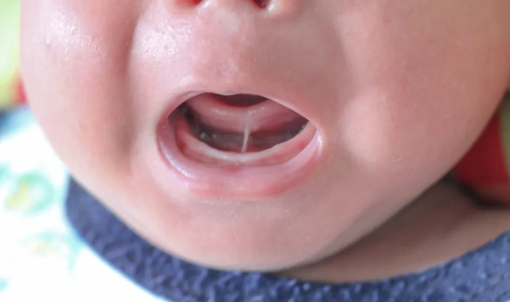 Tongue-tie patient , baby health problem , baby show tongue and gum, Tongue Tie For Babies and Infants.
